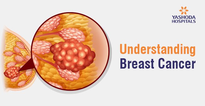 Understanding Breast Cancer