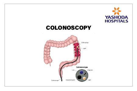 Anal Fissure Causes Symptoms Diagnosis And Treatment