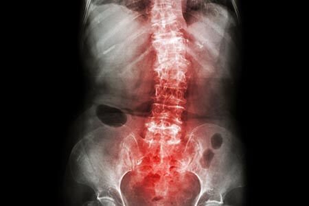 Complications of Spondyloarthritis