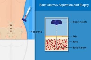 Leukemia: Types, Symptoms, Stages, Causes, Diagnosis, Treatment ...