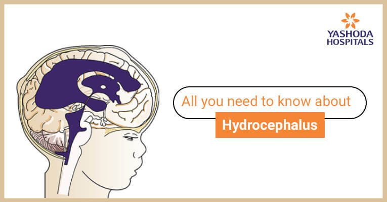 Hydrocephalus Types Symptoms Causes Risk Factors Diagnosis And Treatment 7506