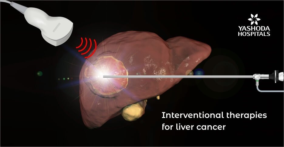 Interventional Radiology Therapies for Liver Cancer