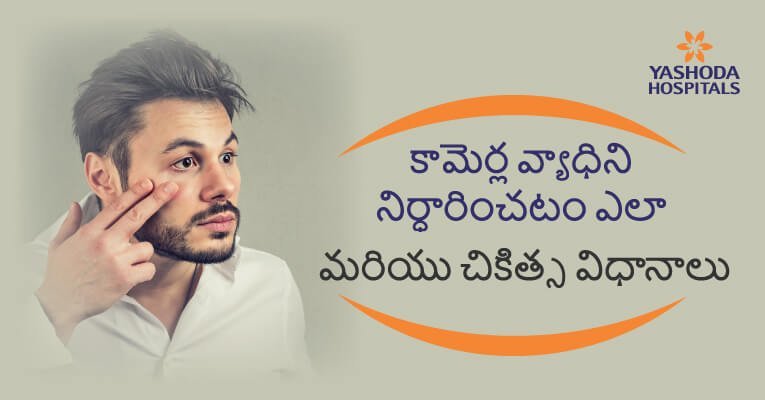 కామెర్ల వ్యాధి లక్షణాలు మరియు చికిత్స విధాన వివరాలు