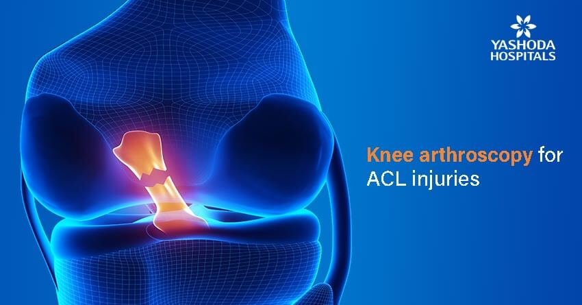 Anterior Cruciate Ligament (ACL) injury – Role of Arthroscopy