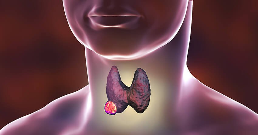 if-you-have-a-lump-in-your-neck-it-could-be-thyroid-cancer