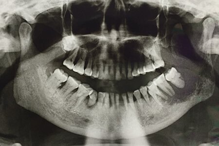 Mouth Cancer Or Oral Cancer Types Symptoms Stages