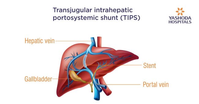 TIPS - Transjugular Intrahepatic Portosystemic Shunt and Portal ...