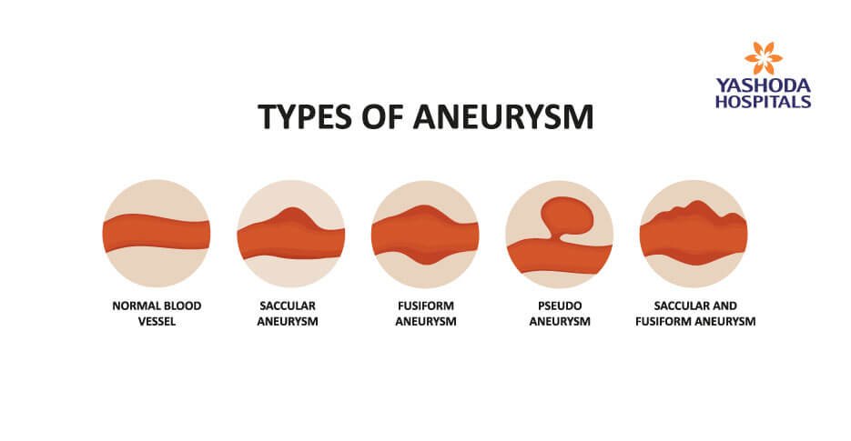 Types Of Saccular Aneurysm