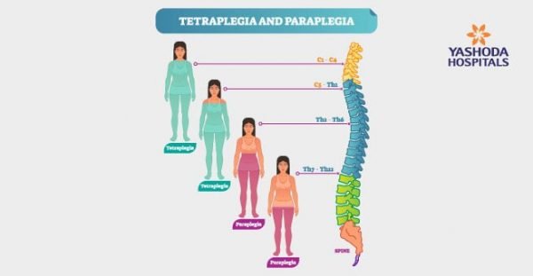 Spinal Cord Injury: Types, Causes, Symptoms, Diagnosis and Treatment