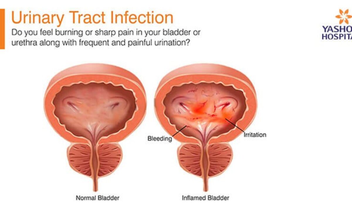 Do you feel burning or sharp pain in your bladder or urethra?