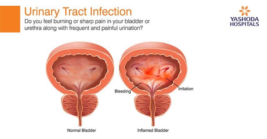 https://www.yashodahospitals.com/wp-content/uploads/urinery-tract-infection.jpg