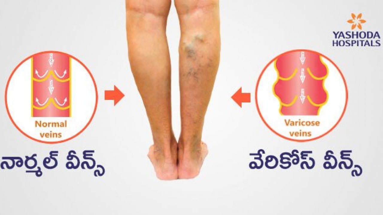 venous-meaning-in-telugu-mapametawan