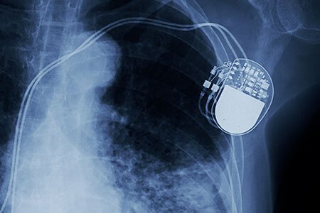 heart monitor implants